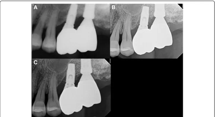 Fig. 8 F2, periapical radiograph, a #27i, prosthesis delivery, b #27i peri-implantitis, #26i increasing radiolucent lesion, c #27i peri-implantitis, #26i mesial bone loss