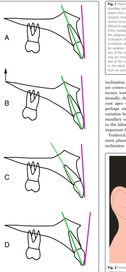 Fig. 2 Female smiling profile view; TrH, true horizontal line; TrV, true vertical line; red vertical line is the tangent to the labial face of the maxillary central incisor crown, and the measured angle is the inclination of the labial face tangent in rela