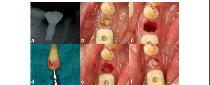 Fig. 1 Pre-operative radiographic (a) and clinical representation of premolar indicated for extraction (b)
