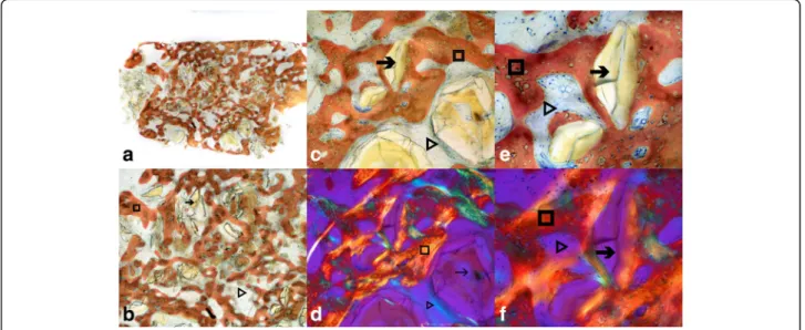Fig. 3 Histologic picture of harvested core in low × 10 (a), medium × 20 (b), high × 40 (c, d), and very high × 100 (e, f) magnifications under direct (a –e) and polarized (d, f) light