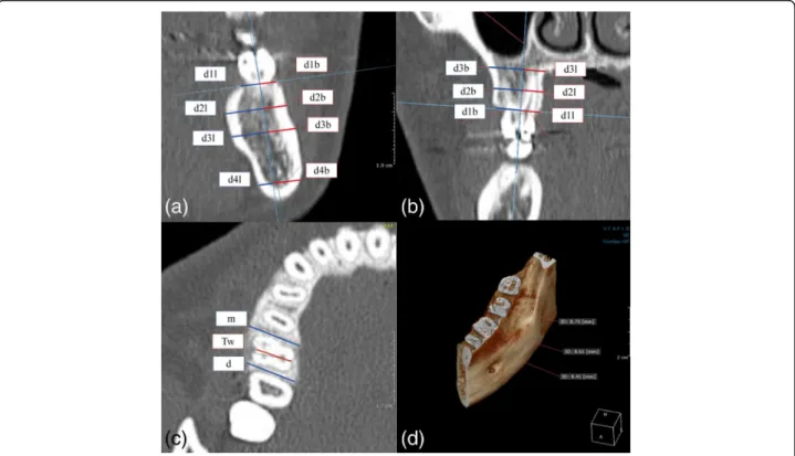 Fig. 2 Measurement of horizontal width of alveolar bone. a Working on a coronal view of the mandibular first molars