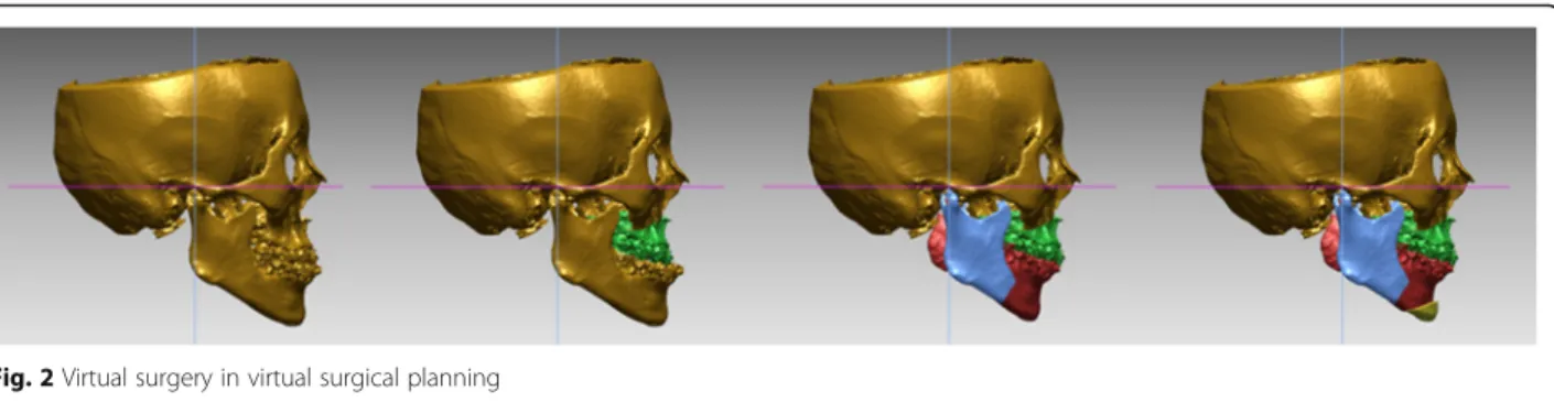 Fig. 2 Virtual surgery in virtual surgical planning