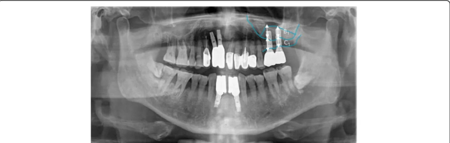 Fig. 4 Post-1 year loading panorama radiograph. Diagram for measuring the height of change of sinus bone graft material and vertical ridge bone graft material