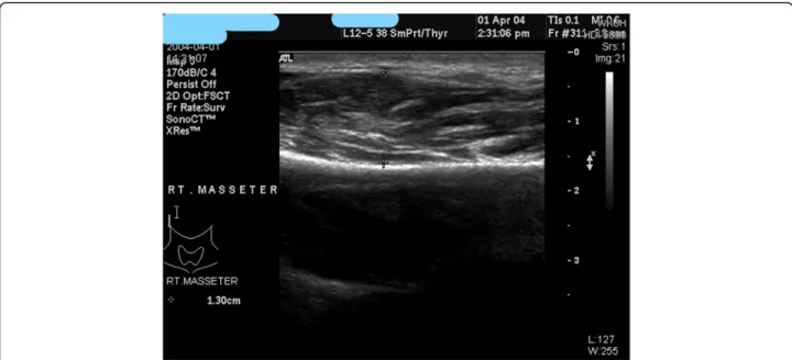 Fig. 14 Type I. muscular type. Hypertrophy of masseteric muscles is prominent, improvement is expected after botulinum toxin A injection