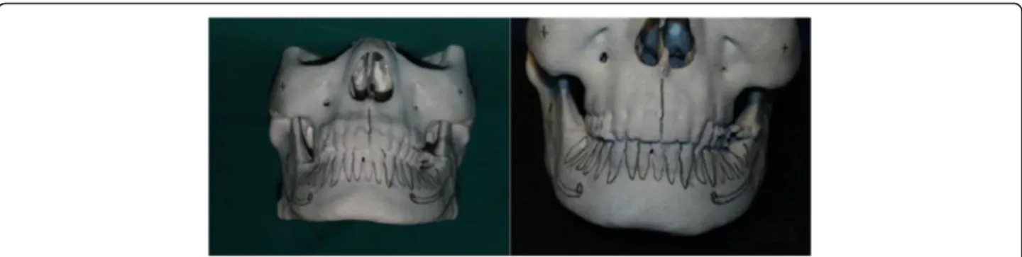 Fig. 16 Type III. Combination type. Patient with outwardly projecting mandibular angle and muscular hypertrophy is observed
