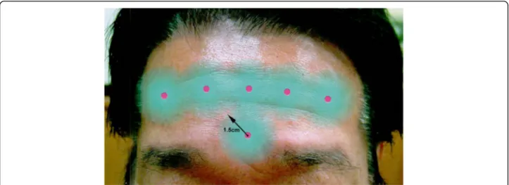 Fig. 5 When injecting botulinum toxin in the forehead wrinkles, noted that the injecting point should be 1.5 –2 cm far away from the eyebrows