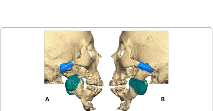 Fig. 3 Right (a) and left (b) side of surgical guides using computer-aided design and computer-aided manufacturing