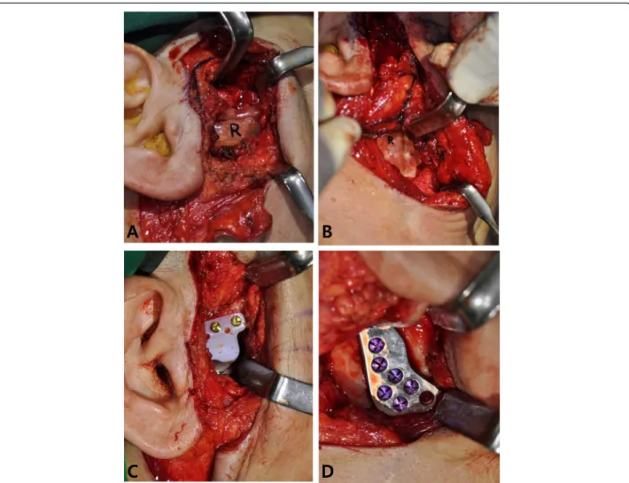 Fig. 4 Intraoperative photographs taken at the right side. Placement of the surgical guide for the fossa component (the most left) and the condyle component (the second most left), and installation of the fossa component (the second most right) and the con