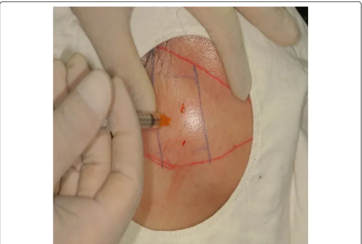 Fig. 13 Injecting botulinum toxin A with an insulin syringe into the injecting point of the masseter muscle within the triangle