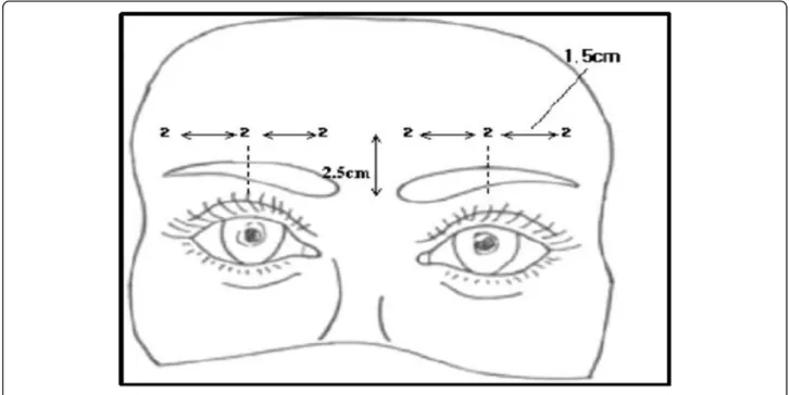 Figure 5 shows 2 weeks after the injection of BTXA
