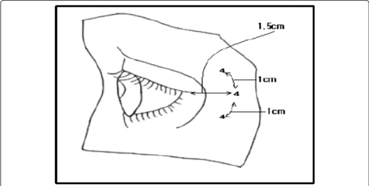 Fig. 6 Schematic representation of injection point for eye wrinkles