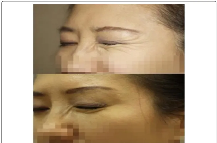 Figure 8 shows a case of a treatment of oral ulcer by
