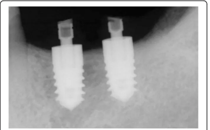Fig. 4 Picture demonstrating the three injection points. Injection point is within the triangle made by a line connecting the mouth corner, the tragus, and the angle of the mandible