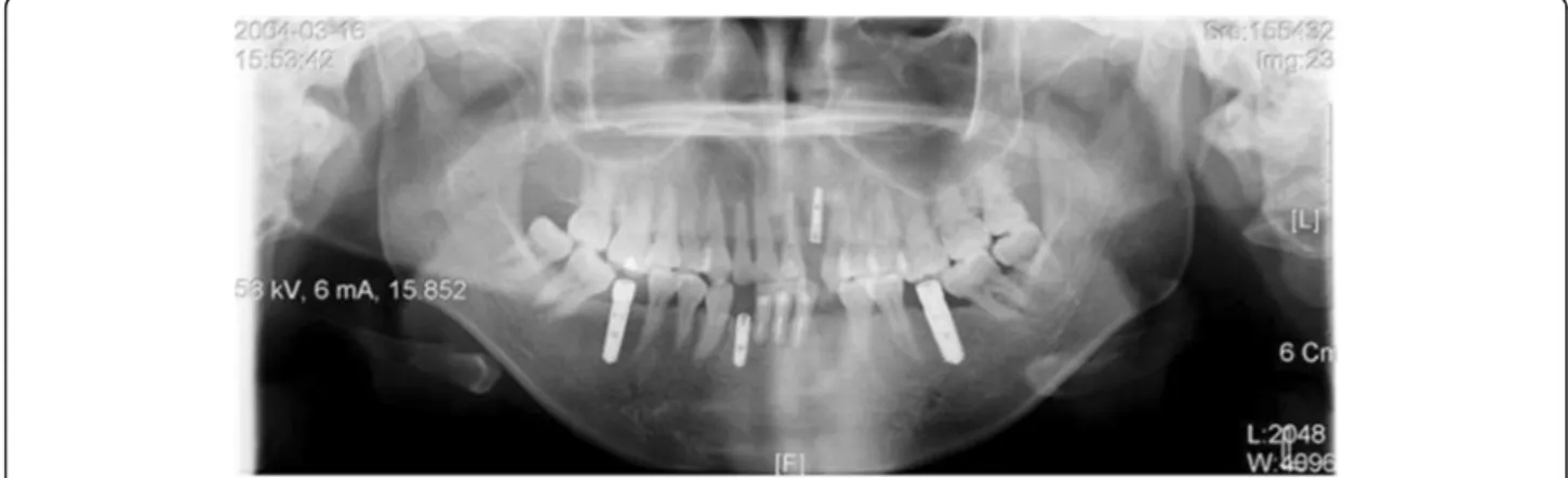 Fig. 5 A case in which the stability of the implant is being threatened due to stimulation on gingival former of the implant which resulted by mesial tilting of #47 and #37 after implant placement