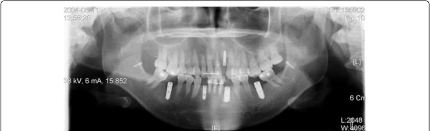 Fig. 6 In 3 months after injecting botulinum toxin into both sides of the masseter muscle and using SAS to upright #37 and # 47, teeth repositioned to normal, and botulism toxin lowered the occlusal force acting on the implant