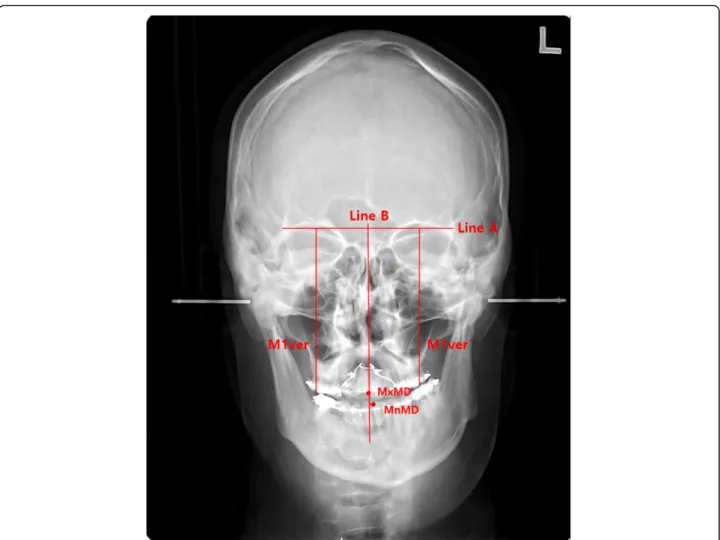 Fig. 1 Evaluation with P-A cephalograms for maxillary, mandibular midline deviation, and maxillary canting