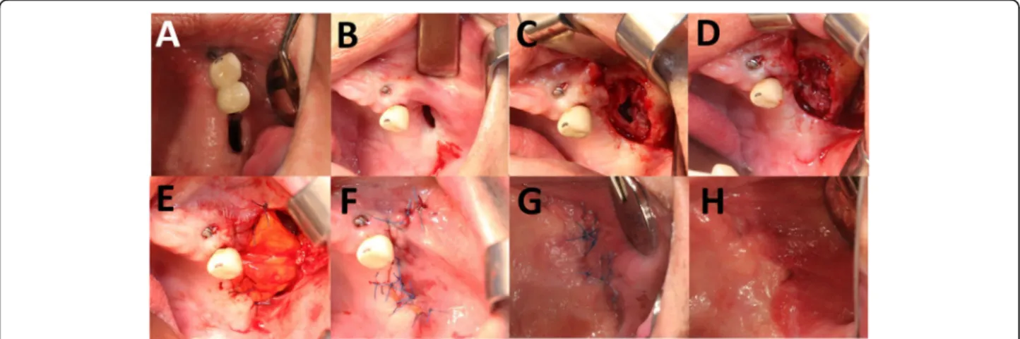 Fig. 1 The two-layer technique using a BFP and a buccal advancement flap. a At the first visit