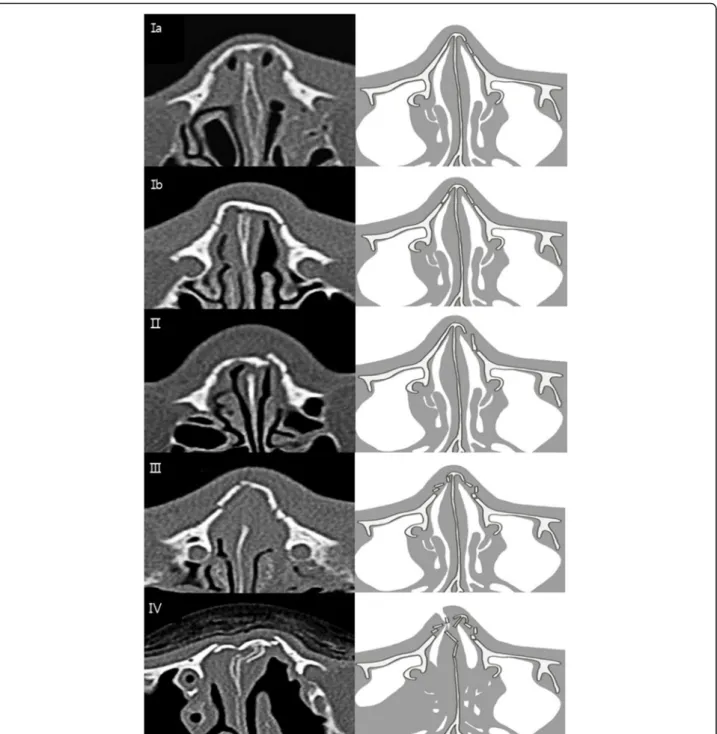 Fig. 1 Classification of nasal bone fracture. Ia Simple unilateral, non-displaced. Ib Simple bilateral, non-displaced
