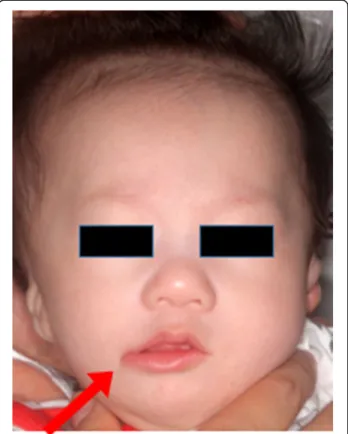 Figure 6 shows the photographs acquired before and 3 months after the surgery. At 3 postoperative months, symmetry was observed between both the oral  commis-sures with satisfactory esthetic reconstruction, and there were no functional postoperative compli