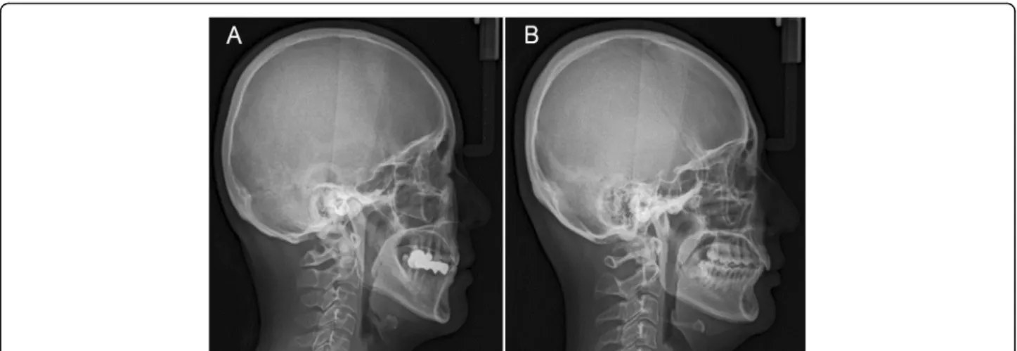 Fig. 3 Representative views of lateral cephalometry show the different morphology of the soft palate, mandible, and hyoid bone between male (a) and female (b) with obstructive sleep apnea
