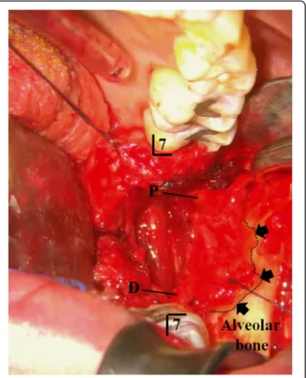 Fig. 1 The granuloma and peripheral neuroma. The removed torn LN and scar tissue was about 14mm length