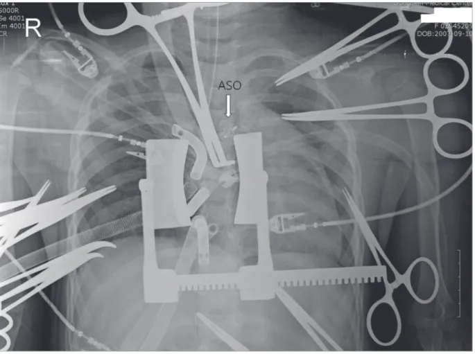 Fig. 1. The ASO embolized at ascending aorta between aortic cross clamp and aortic cannula