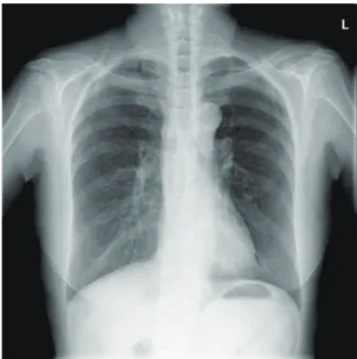 Fig. 1. Chest X-ray. There is no evidence of lung  mass or nodule.