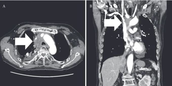Fig. 1. Computed tomography shows lymph node enlargement and superior vena cava (SVC) compression  (2015.01)