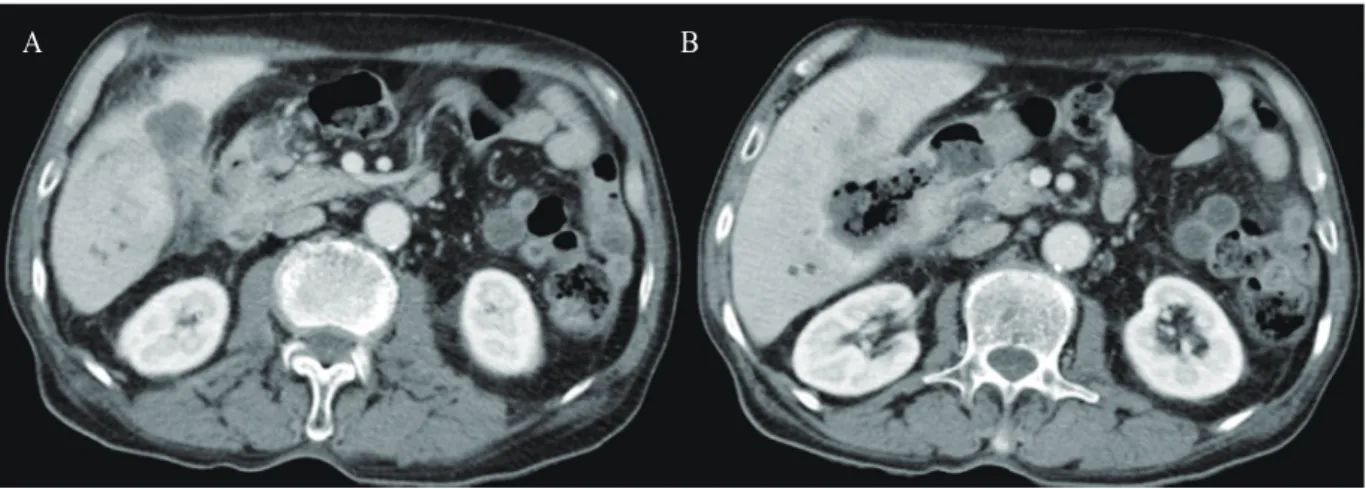 Fig. 1. Abdominal computed tomography scan. (A) Heterogeneous mass at the gallbladder