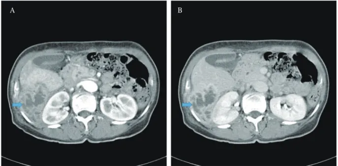 Fig. 1. (A) Contrast-enhanced abdominal computed tomographic findings. On the arterial phase, the  heterogeneously defined 7.5 cm sized necrotic mass with peripheral enhancing wall (arrow) is noted