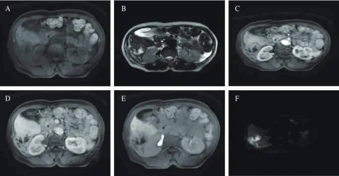 Fig. 3. Liver MRI findings. (A) On T1W images the lesion with irregular borders appears hypointense