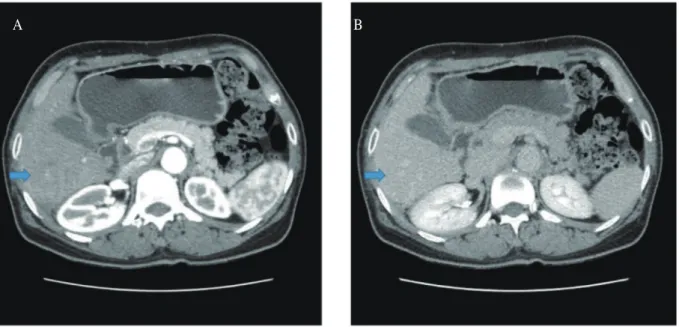 Fig. 6. Follow-up dynamic abdominal CT findings. 6 months after the initial CT (Fig. 1)