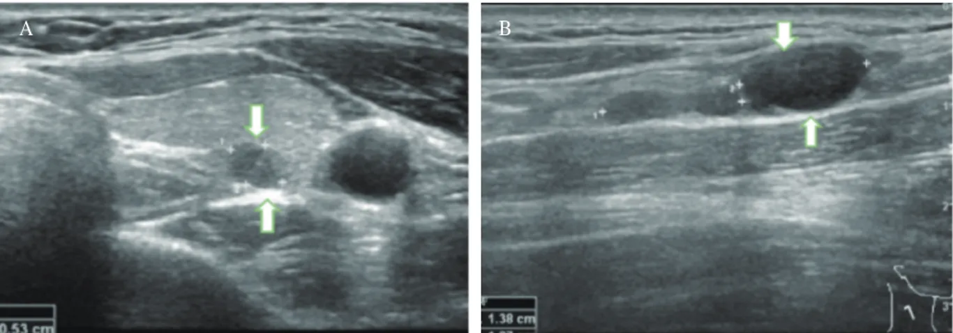 Fig. 1. (A) Thyroid sonography (transverse view) shows 5.4 × 3.8 mm sized hypoechoic lesion in the left lower  lobe of thyroid gland