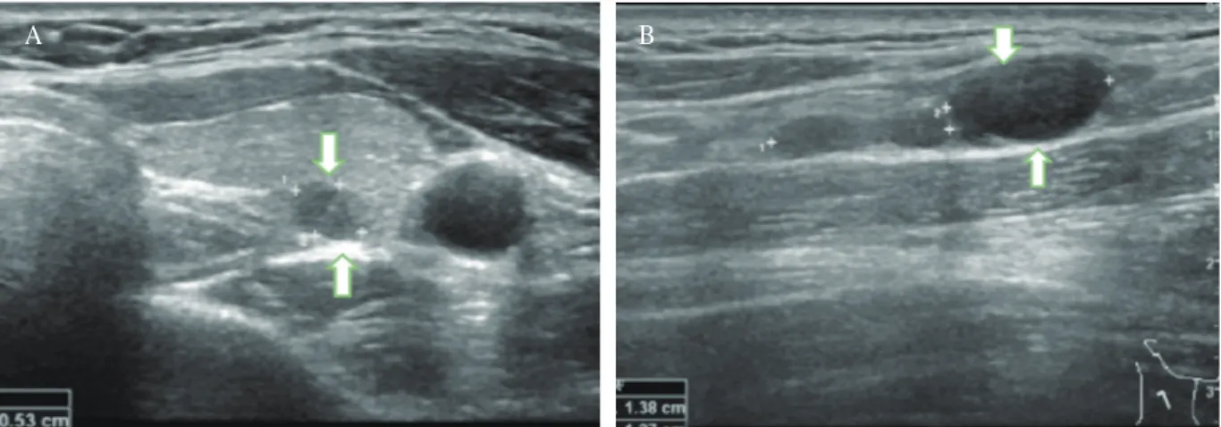Fig. 1. (A) Thyroid sonography (transverse view) shows 5.4 × 3.8 mm sized hypoechoic lesion in the left lower  lobe of thyroid gland