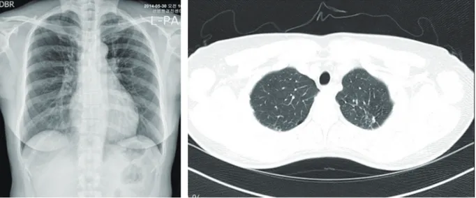 Fig. 2. Chest X-ray and computed tomography show inactive tuberculosis lesions in the left upper lung field.