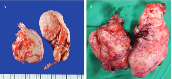Fig. 3. Macroscopic views of the giant benign prostatic hyperplasia weighed as 330 gm.