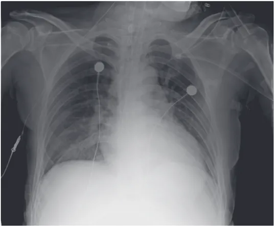 Fig. 1. The chest radiograph after intubation shows abnormal pulmonary infiltrations  in the right lower lung field