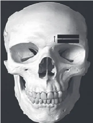 Fig. 1. The direction of transducer position (arrow)  scanning the forehead to identify the supraorbital  notch or foramen.