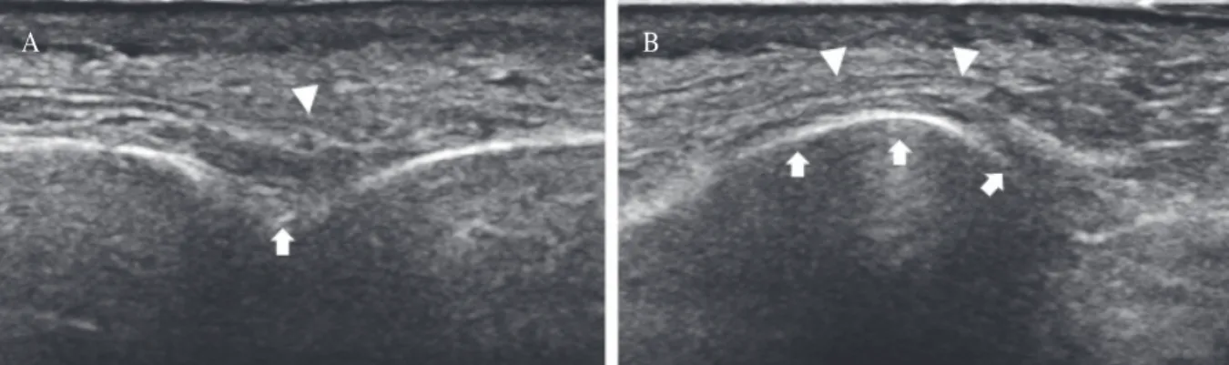 Fig. 3. An ultrasound image of the block needle with longitudinal (A) and transverse (B) view