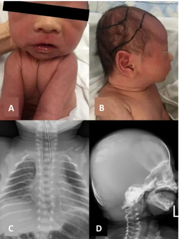 Figure 1.  The infant, displaying features characteristic of cleido- cleido-cranial dysplasia (CCD)