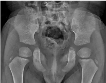 Figure 3.  Chest and neck radiographs taken at 4 years of age. (A) The bilateral dysplastic  clavicles observed after birth remain underdeveloped