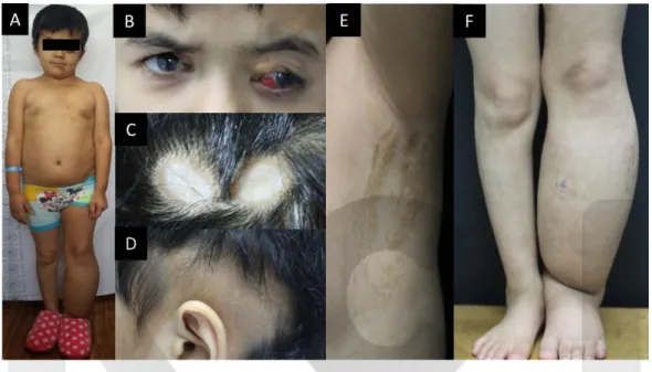 Fig. 1. Morphologic characteristics of a girl with encephalocraniocutaneous lipomatosis and Jaffe-Campanacci syndrome