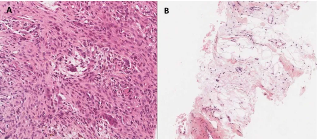 Fig. 4. Histopathologic findings in a girl with encephalocraniocutaneous lipomatosis and Jaffe-Campanacci syndrome