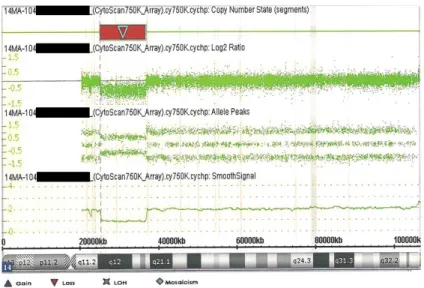 Figure 3.  Chromosomal microarray data from the patient showing the  chromosome 14q12q13.3 deletion (red inverse triangle).
