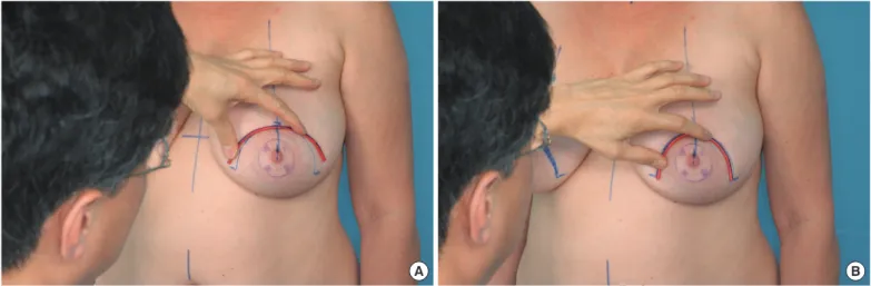 Fig. 1. Preoperative mosque dome design. The preoperative modified mosque dome (areolar opening) skin markings are shown