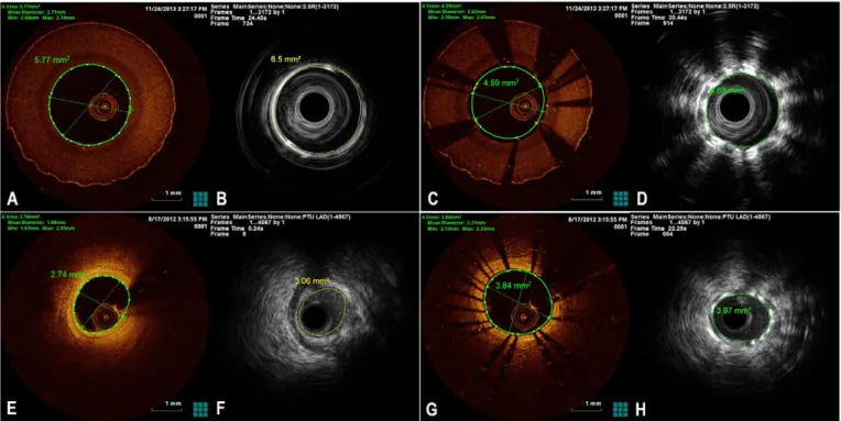 Fig. 1. Representative images of FD-OCT and IVUS at the same segment of phantom reference (A and B), phantom stent (C and D), human coronary artery (E and F), and human coronary artery with stent (G and H).