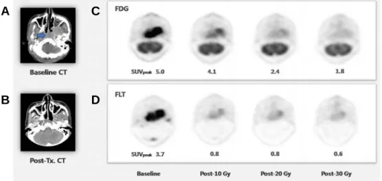 Figure  1.  Serial  transverse  axial  images  of  FDG  PET  (C)  and  FLT  PET  (D)  in  Patient  1  demonstrate  uptake  changes  in  tumor  after  radiotherapy