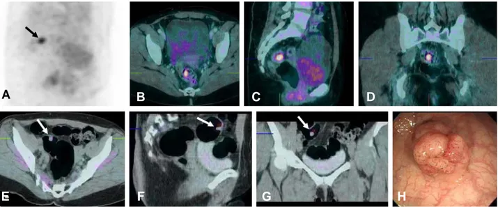 Figure  2.  A  46-year-old  female  with  a  history  of  thyroid  cancer  operation  performed  follow-up  PET/CT