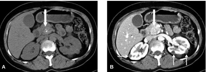 Figure  1.  Present  non-enhanced  (A)  and  enhanced  (B)  abdominal  axial  CT  images  show  a  3.6  cm  sized,  slightly  hypoattenuating  mass  (thick  arrows)  with  central  calcification  in  the  head  and  uncinate  process  of  the  pancreas  wi