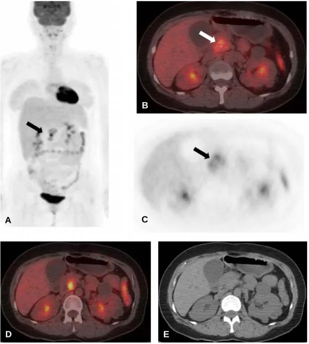 Figure  2.  MIP  (A)  image  of  F-18  FDG  PET/CT  shows  a  vertically  aligned  bow  tie  shaped  hypermetabolic  lesion  in  the  upper  abdomen